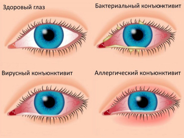 vospalenie-glaz-tetratsiklin-maz